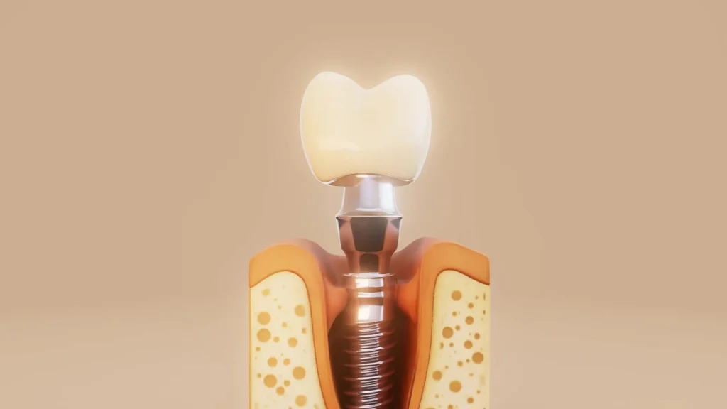 معرفی بهترین برندهای ایمپلنت دندان در ایران (سال ۲۰۲۵): راهنمای انتخاب برای بیماران