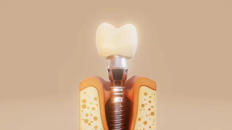 معرفی بهترین برندهای ایمپلنت دندان در ایران (سال ۲۰۲۵): راهنمای انتخاب برای بیماران