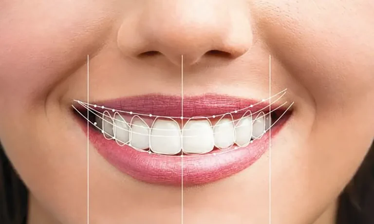 طراحی لبخند دیجیتال (DSD) چیست و چگونه به خلق یک لبخند بی‌نقص با لمینت کمک می‌کند؟