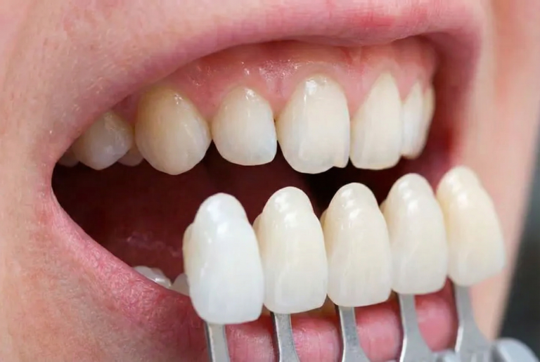 بهترین سن برای لمینت و کامپوزیت دندان: راهنمای کلینیک دکتر هومن امیری